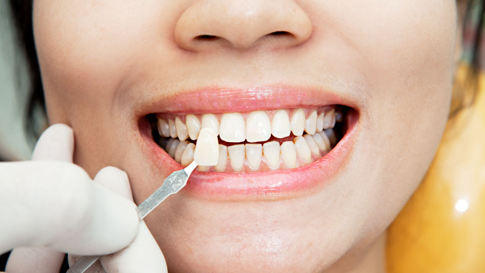 Know The Aftercare Instructions Of Porcelain Veneers – To Increase Their Lifespan