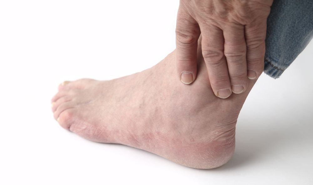 Know More about Gout Causes, Symptoms, and Treatments