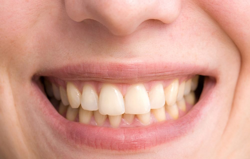 Yellow Teeth: What Causes Them?