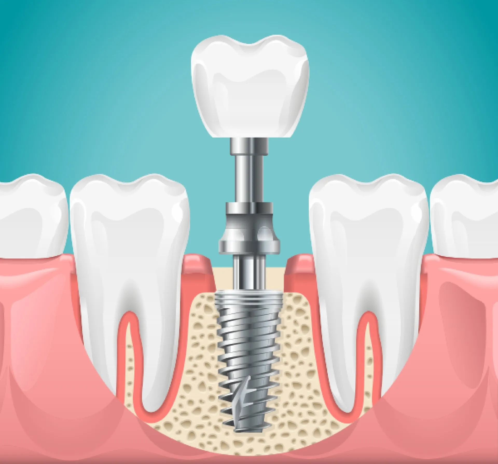 Getting Dental Implants? Ask These Questions to Your Dentist First!