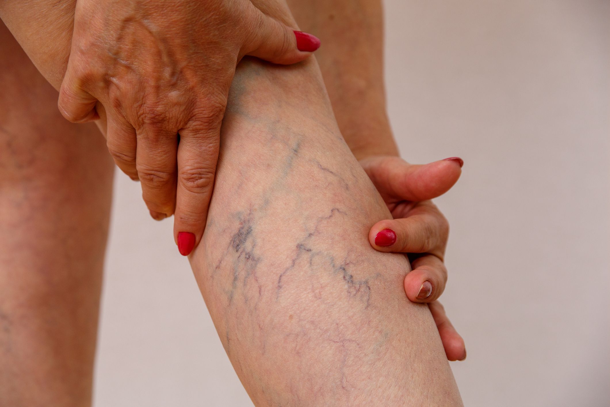 Your Go-To Guide To Spider Veins And Available Treatments 