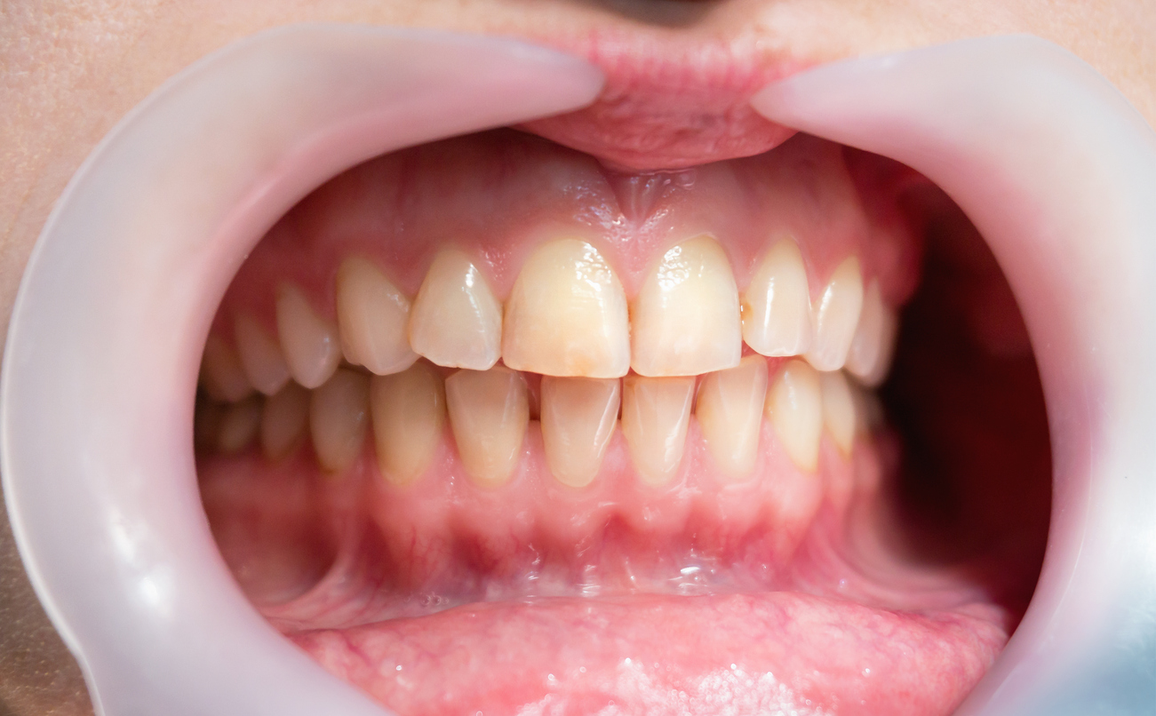 What are the Major Benefits of Gum Grafting?