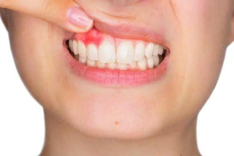 Gum disease 101: All about gingivitis and periodontitis