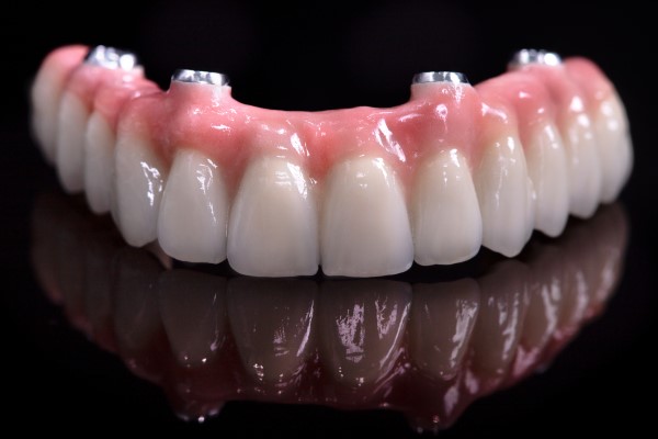 What You Should Know About Dentures Over Implants
