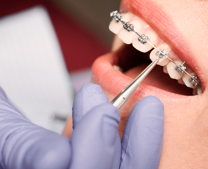 How to Find the Right Orthodontist: Frequently Asked Questions