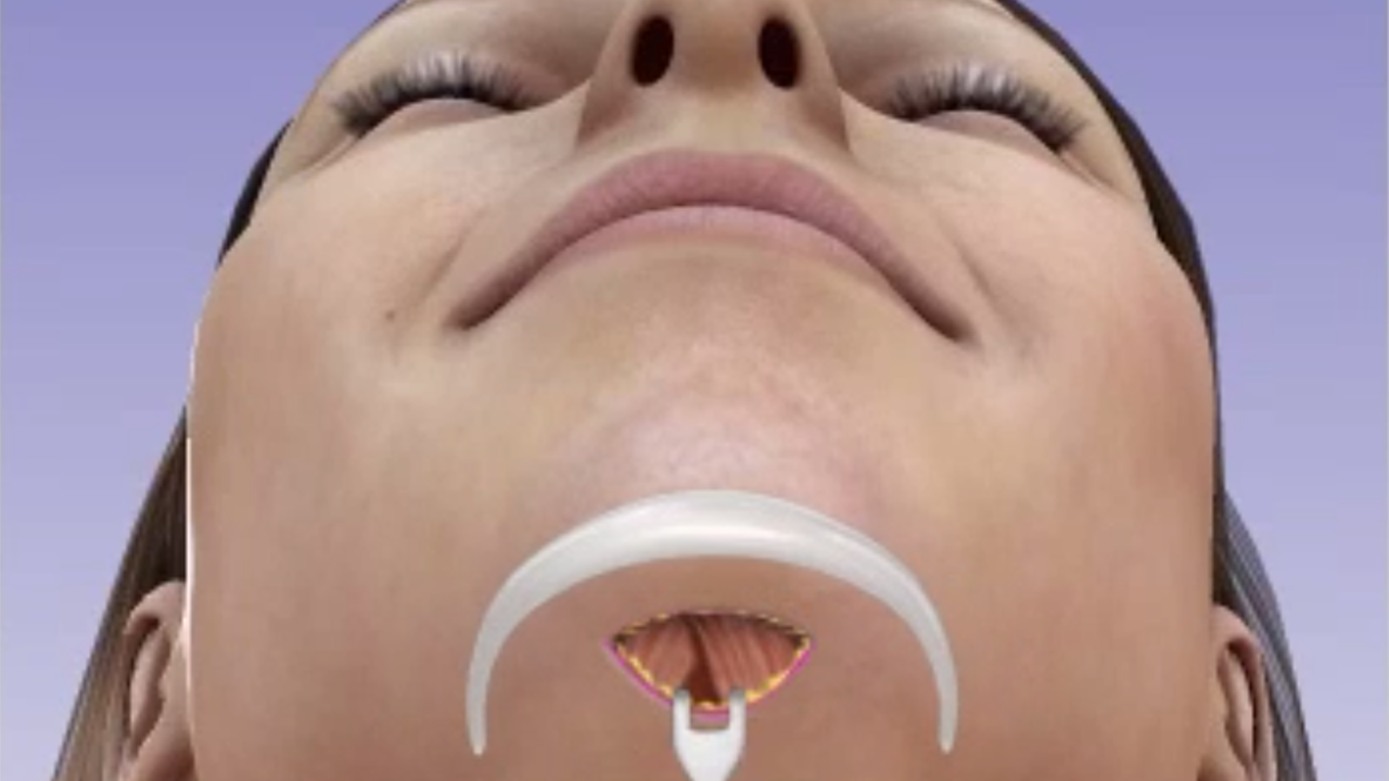 How to Prepare for a Chin Implant Surgery
