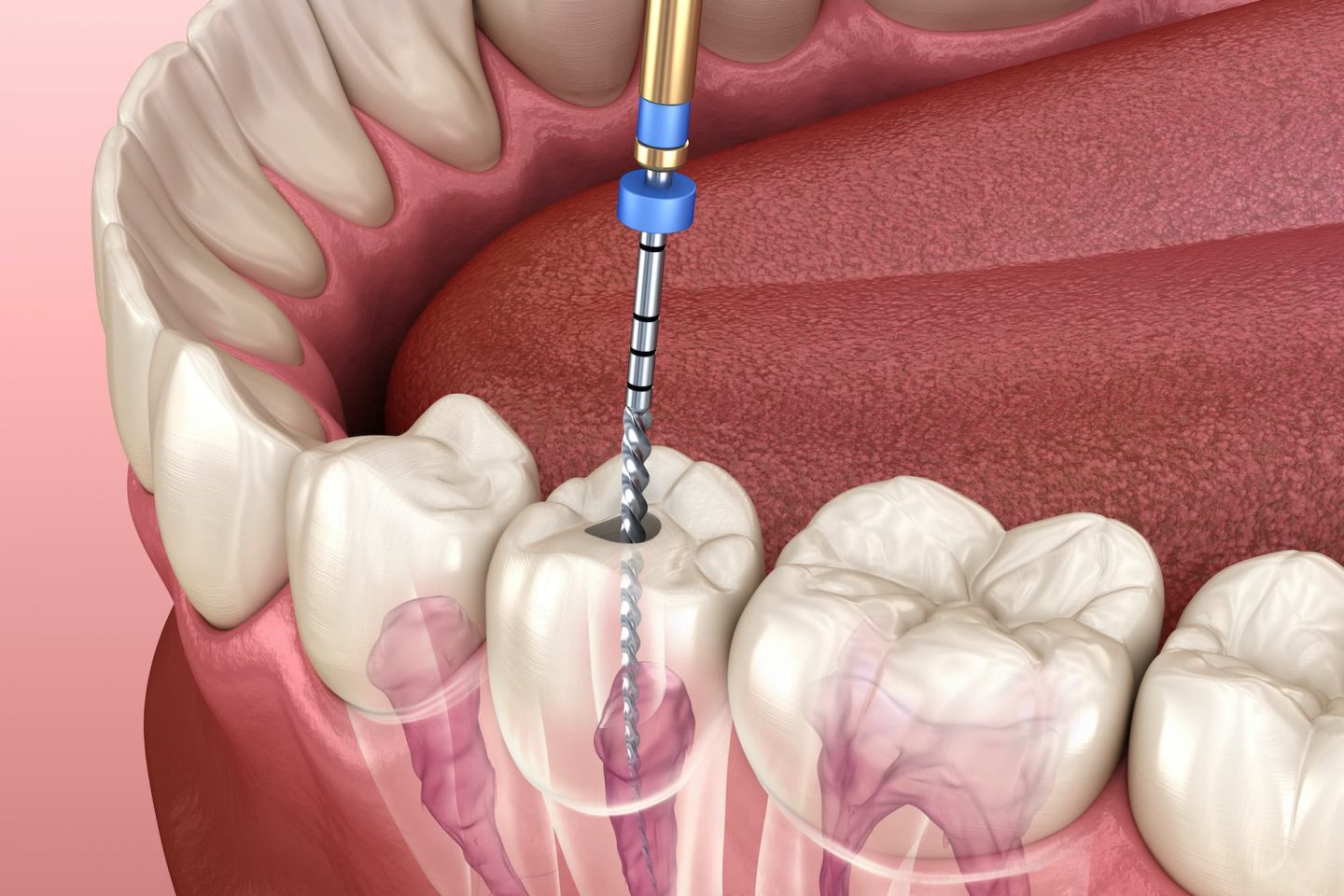 3 Main Reasons to Consider Getting a Root Canal Therapy