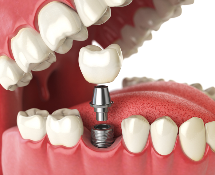 What Are the Benefits of Dental Implants Over Traditional Bridges and Dentures?