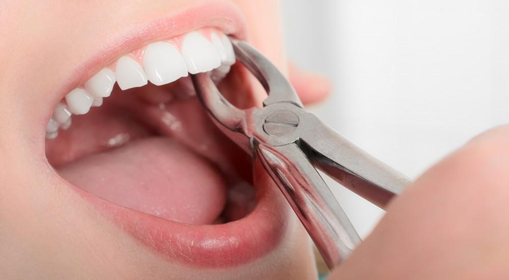 Preventing Dry Socket After Extracting a Tooth