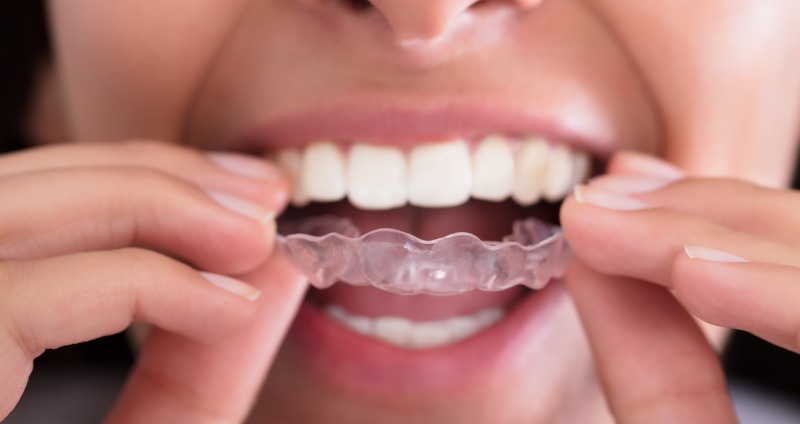 The Importance of Wearing Retainers After Orthodontic Treatment