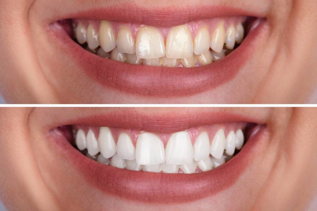 How to Make the Results of Professional Teeth Whitening Stay