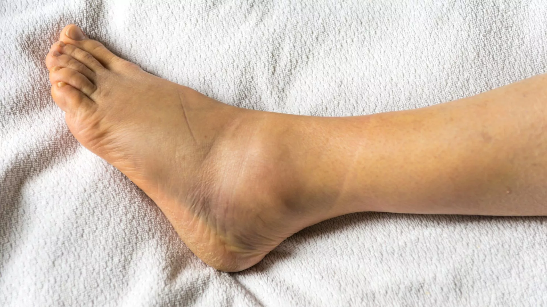 Common Ankle Injuries and Their Treatment You Must Know