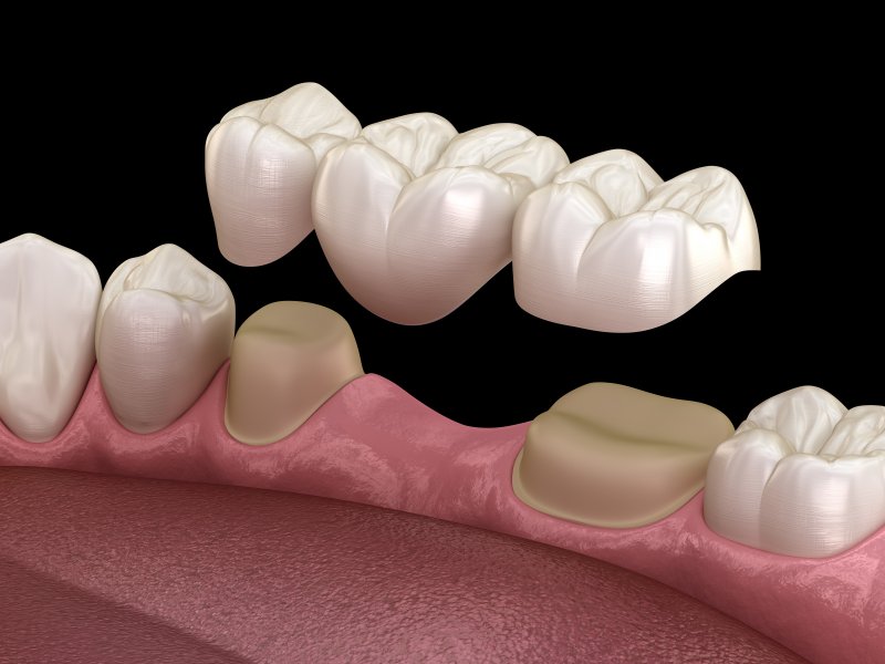 How Long Do Dental Bridges Last?