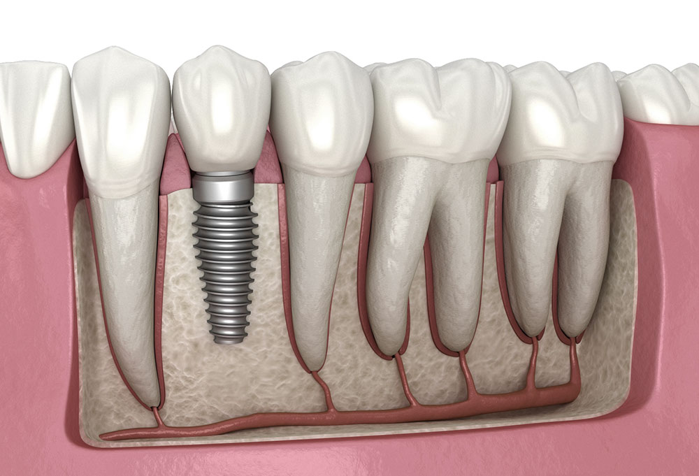 Care Following Treatment for Dental Implants