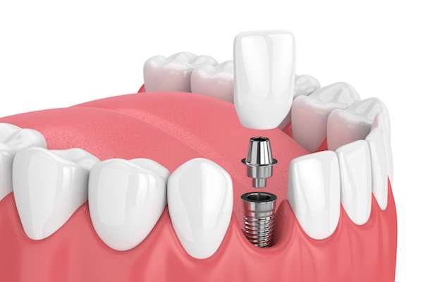 Are Dentures or Dental Implants the Right Tooth Replacement Option for You in Vista?