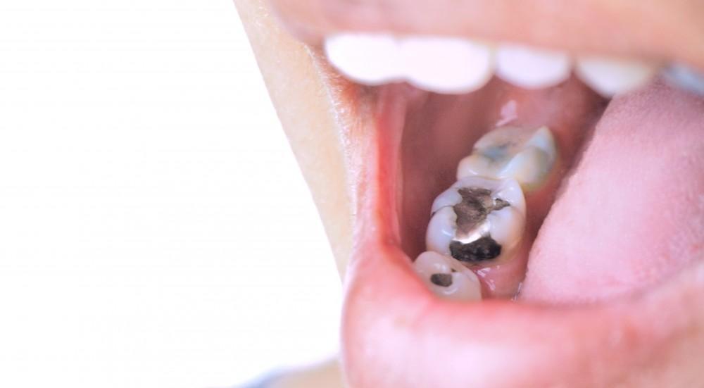 Why Should You Consider Getting Composite Fillings in Drexel Hill?