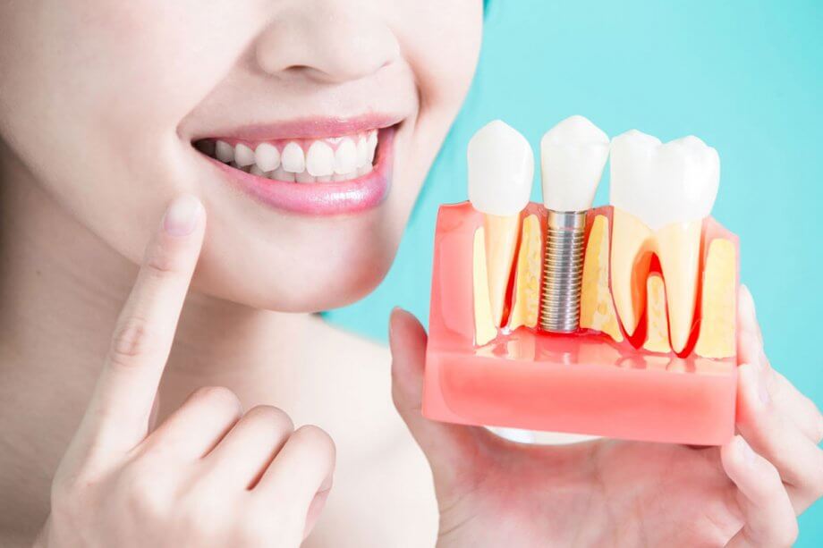 Benefits of dental implants