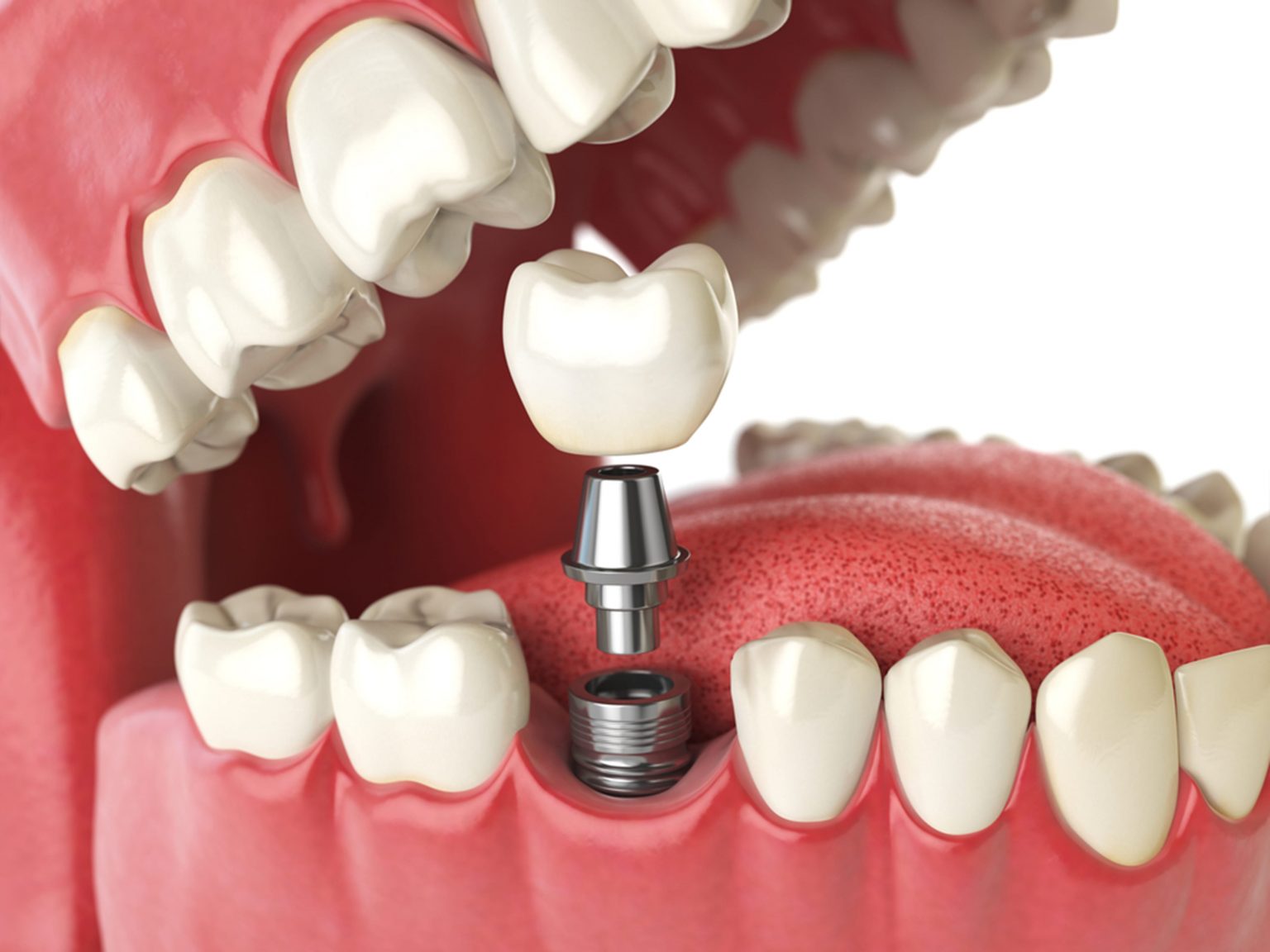 Examining the Numerous Advantages of Getting Dental Implants