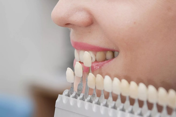 Dental Problems You Can Solve With Veneers