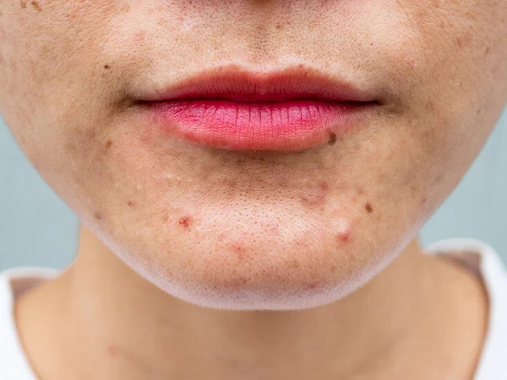 9 Causes of Acne You Should Know
