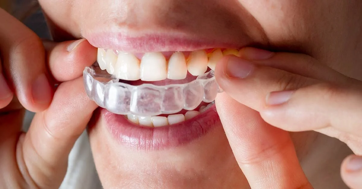 What are the benefits of Invisalign?