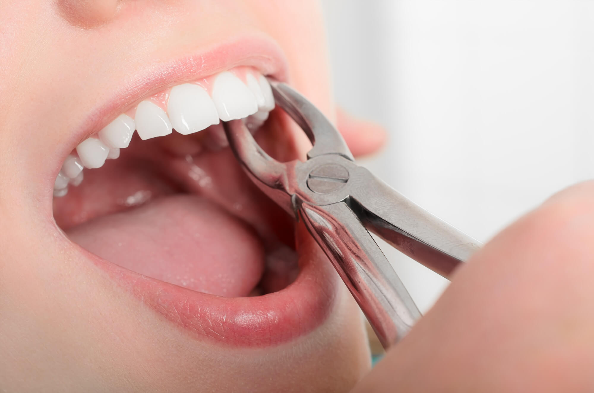 Your Journey Through Tooth Extractions