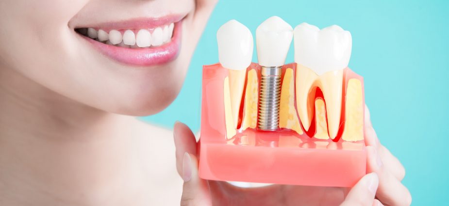 Dental Implants Have Some Major Advantages.