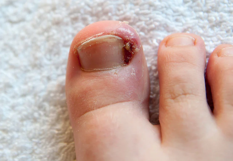 Causes and Treatment Options for Ingrown Toenails in Clarksville