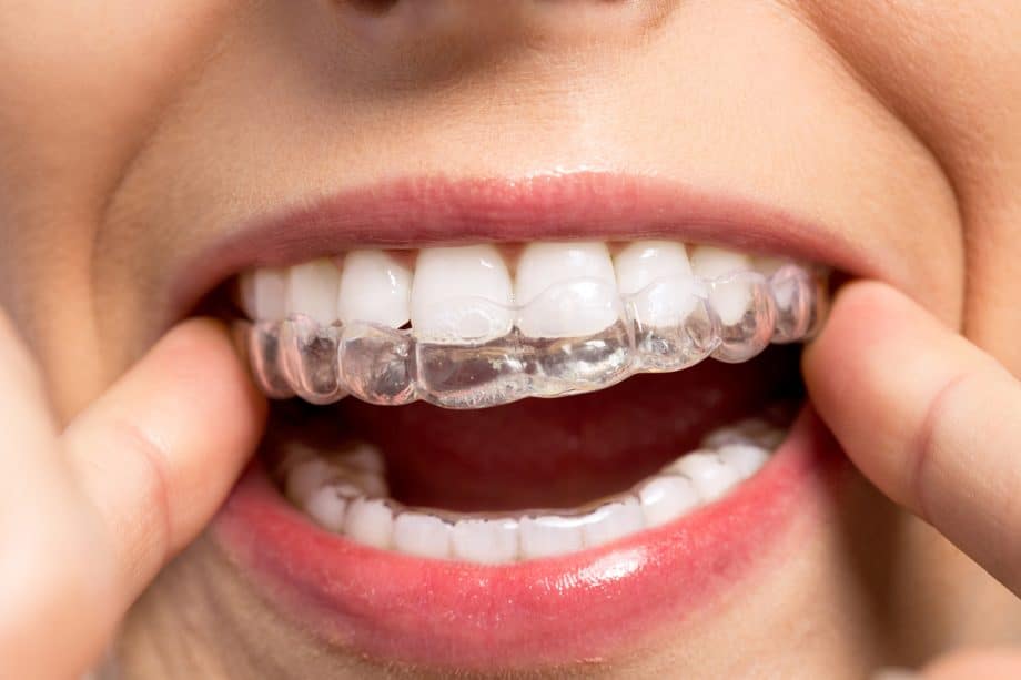 The Pros and Cons of Invisalign Treatment