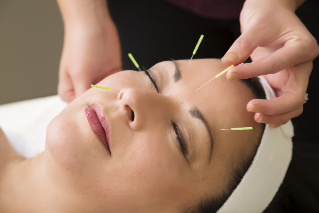 Acupuncture for Stress Relief: How It Works