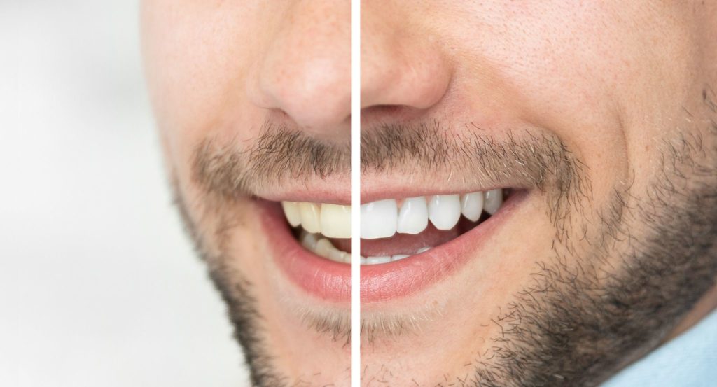 Whitening Options: Professional vs At-Home