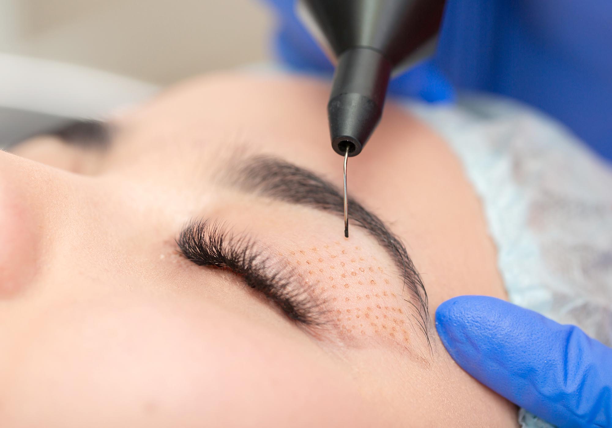 Upper Eyelid Lifting: How to Revitalize Your Look without Surgery