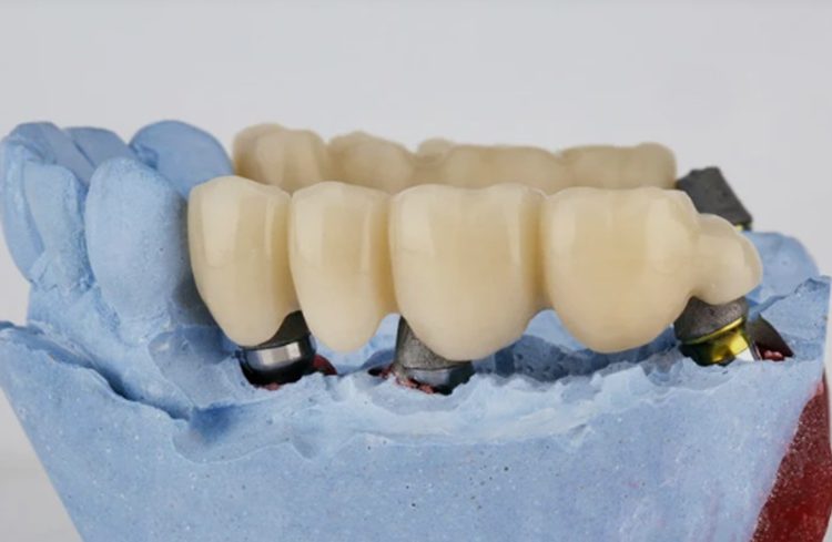 Restoring Oral Functionality