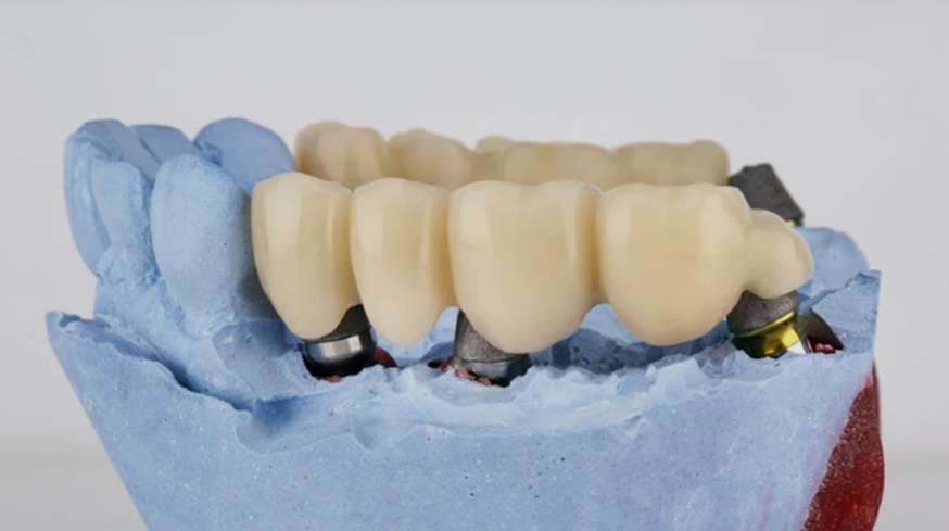 Understanding the Role of Dental Bridges in Restoring Oral Functionality